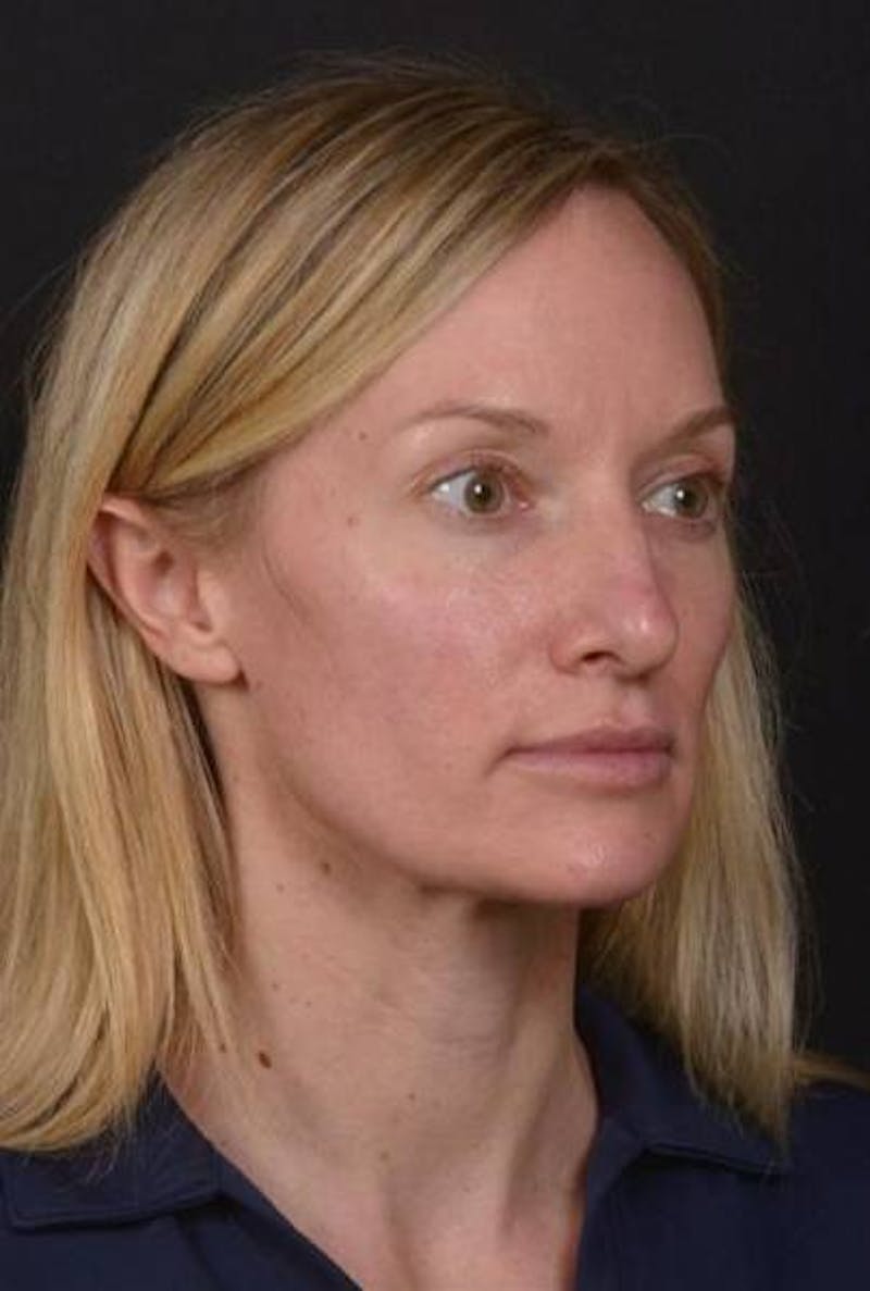 Rhinoplasty Before & After Gallery - Patient 383581 - Image 7