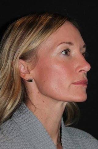 Rhinoplasty Before & After Gallery - Patient 383581 - Image 8