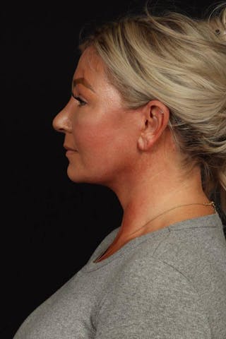Facelift Before & After Gallery - Patient 413878 - Image 6