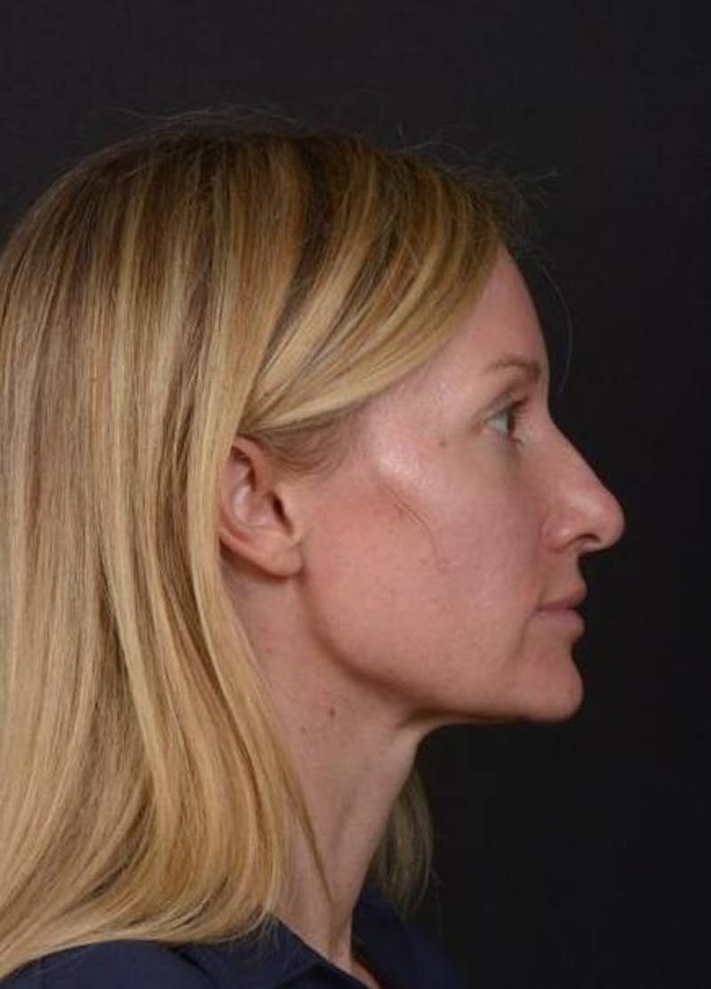 Rhinoplasty Before & After Gallery - Patient 383581 - Image 9