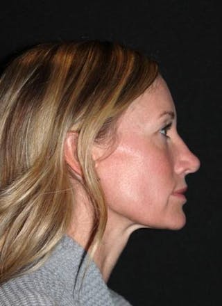 Rhinoplasty Before & After Gallery - Patient 383581 - Image 10