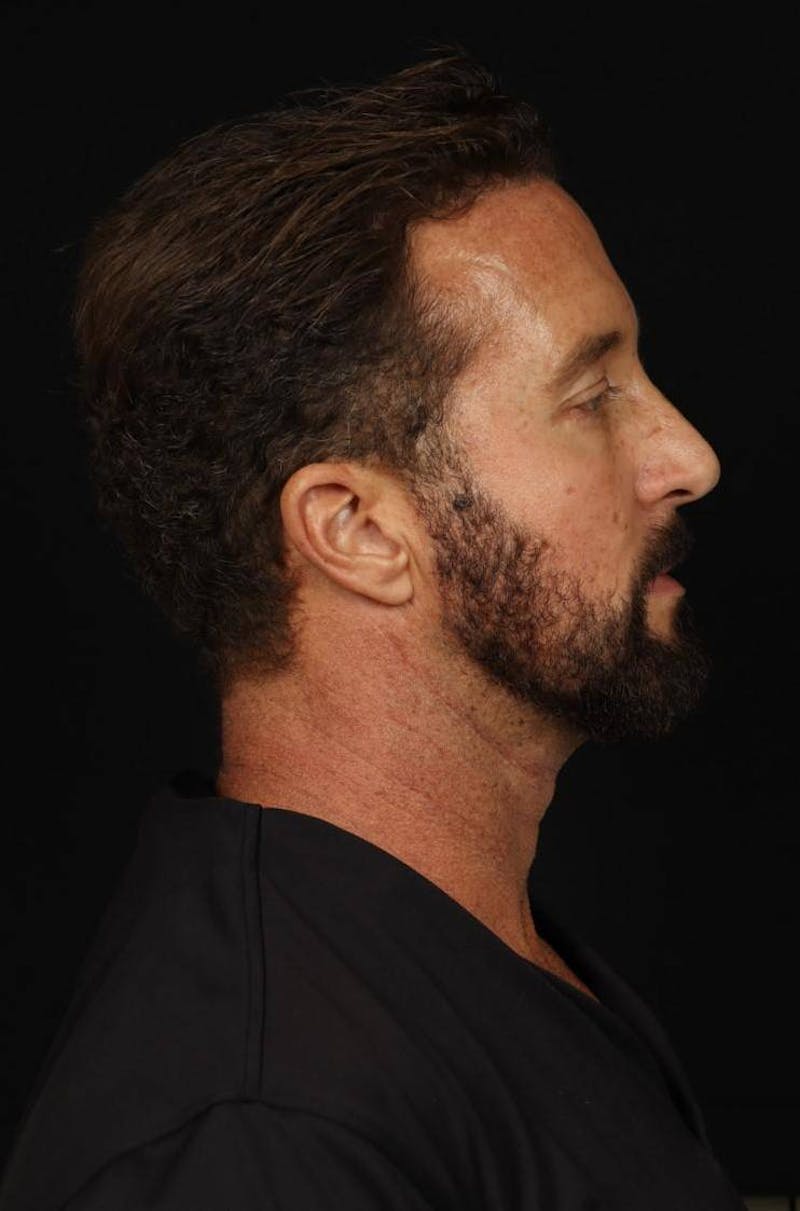 Blepharoplasty Before & After Gallery - Patient 292990 - Image 9