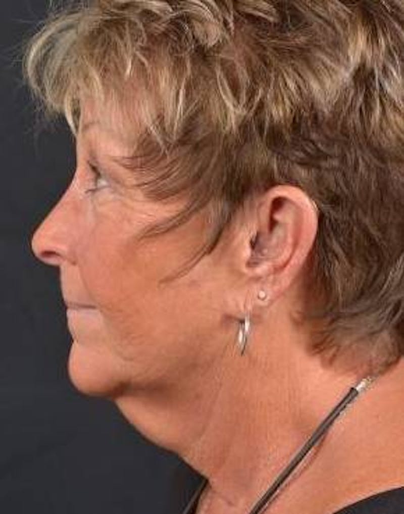 Facelift Before & After Gallery - Patient 130201 - Image 3