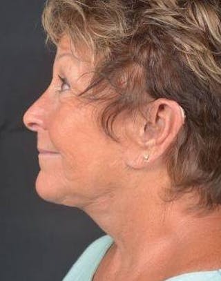 Facelift Before & After Gallery - Patient 130201 - Image 4