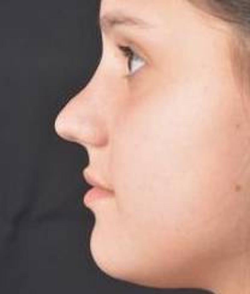 Rhinoplasty Before & After Gallery - Patient 378269 - Image 3