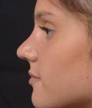 Rhinoplasty Before & After Gallery - Patient 378269 - Image 4