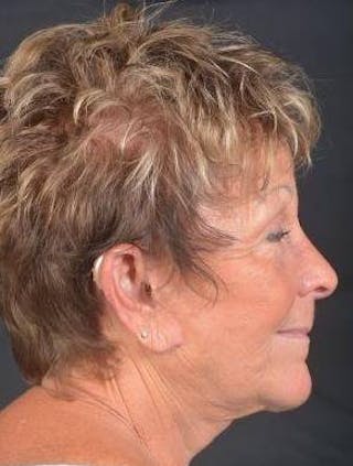 Facelift Before & After Gallery - Patient 130201 - Image 6