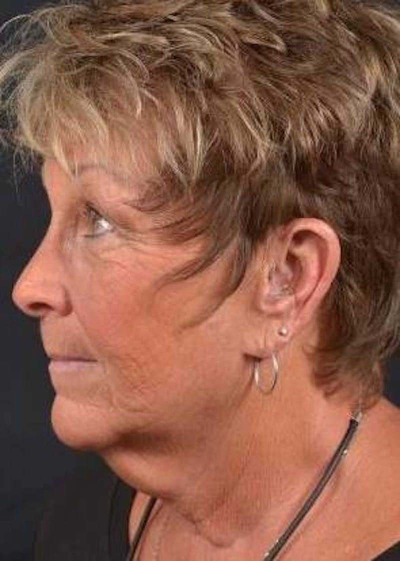 Facelift Before & After Gallery - Patient 130201 - Image 7