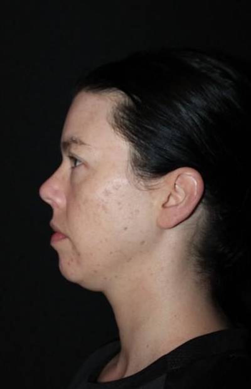 Blepharoplasty Before & After Gallery - Patient 704819 - Image 5