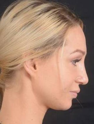 Rhinoplasty Before & After Gallery - Patient 186387 - Image 6