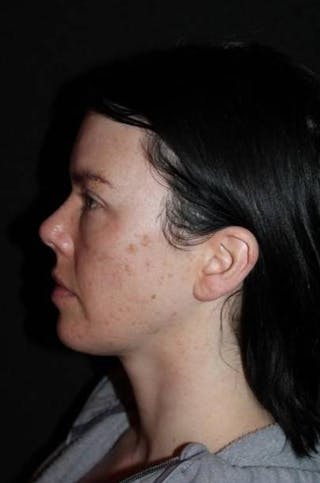 Blepharoplasty Before & After Gallery - Patient 704819 - Image 6