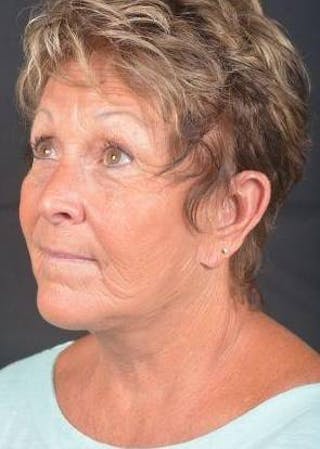 Facelift Before & After Gallery - Patient 130201 - Image 8