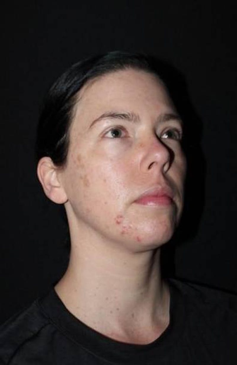 Blepharoplasty Before & After Gallery - Patient 704819 - Image 7