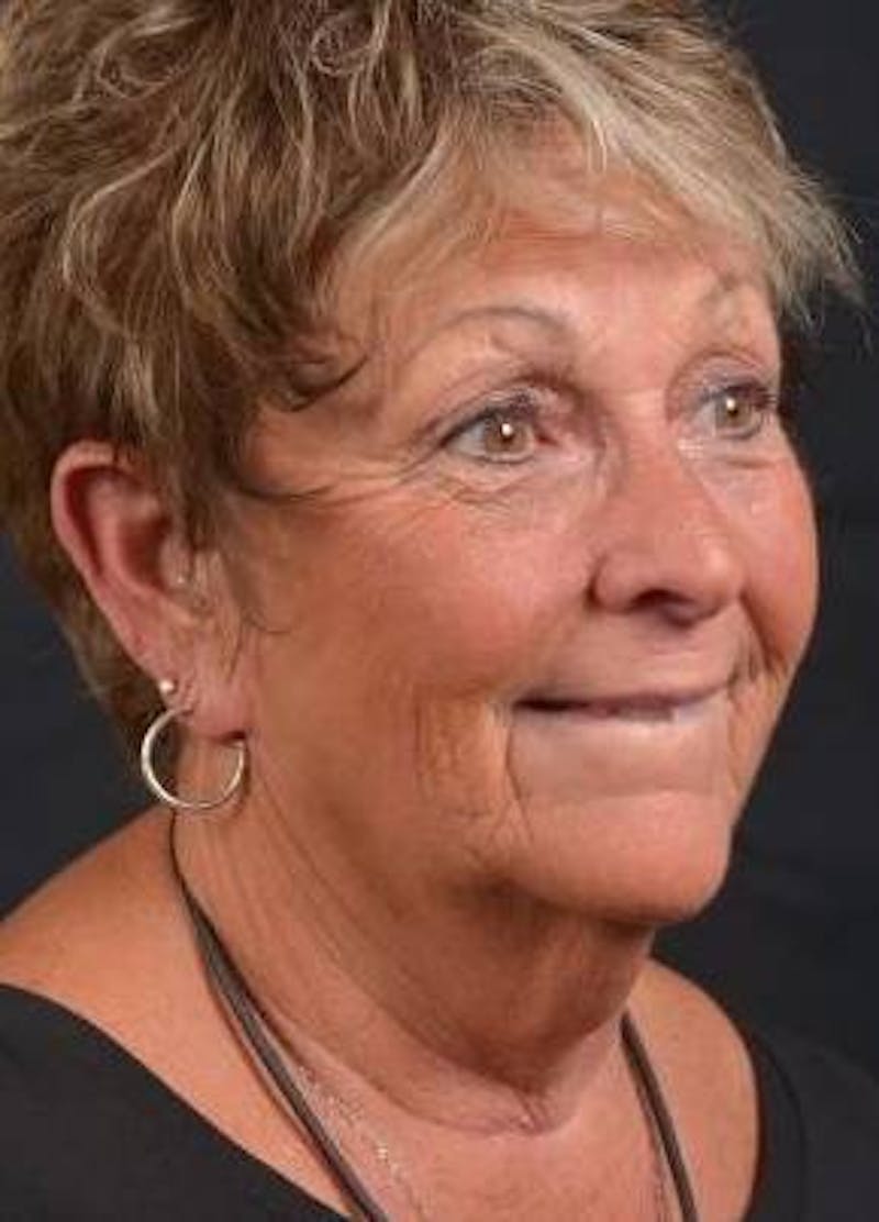 Facelift Before & After Gallery - Patient 130201 - Image 9