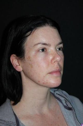 Blepharoplasty Before & After Gallery - Patient 704819 - Image 8