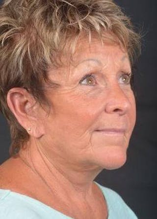 Facelift Before & After Gallery - Patient 130201 - Image 10