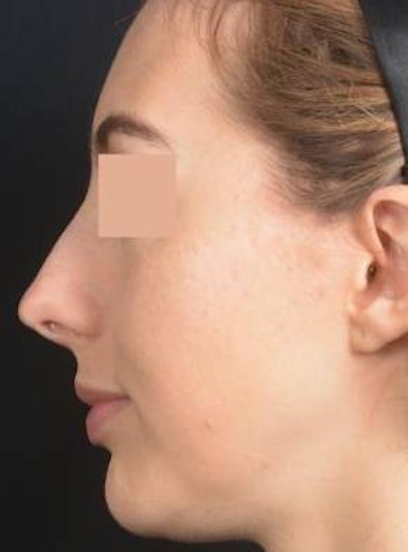 Rhinoplasty Before & After Gallery - Patient 338088 - Image 3