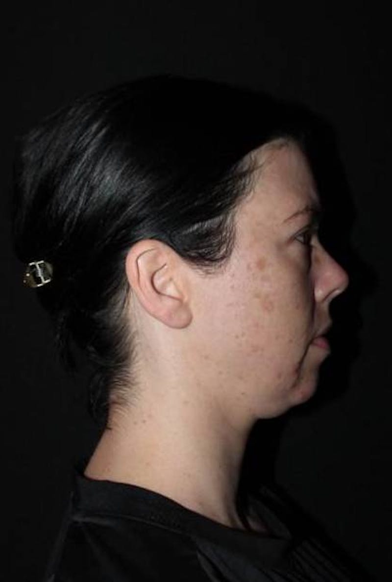 Blepharoplasty Before & After Gallery - Patient 704819 - Image 9