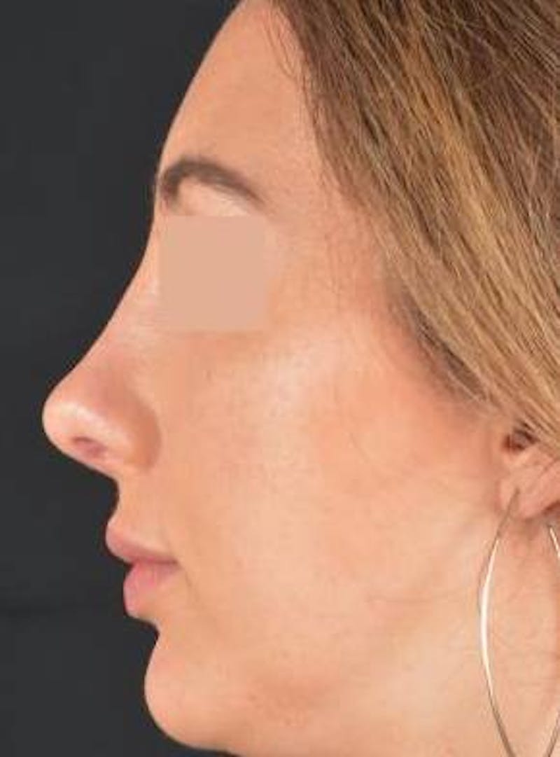 Rhinoplasty Before & After Gallery - Patient 338088 - Image 4
