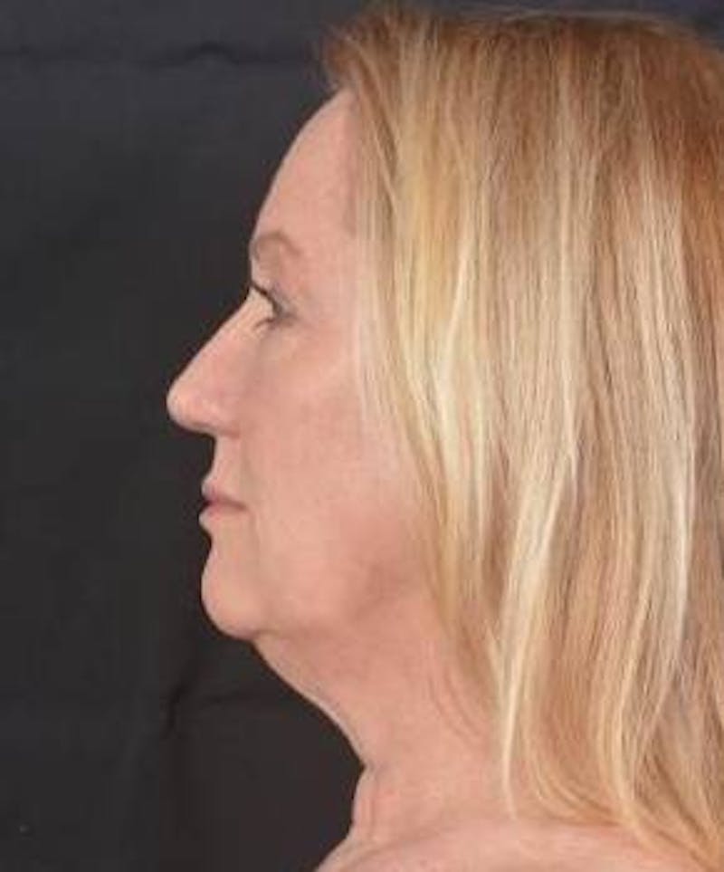 Facelift Before & After Gallery - Patient 366547 - Image 3