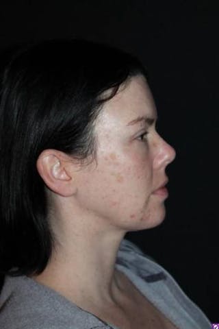 Blepharoplasty Before & After Gallery - Patient 704819 - Image 10