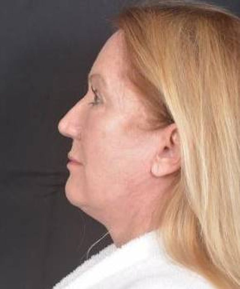 Facelift Before & After Gallery - Patient 366547 - Image 4