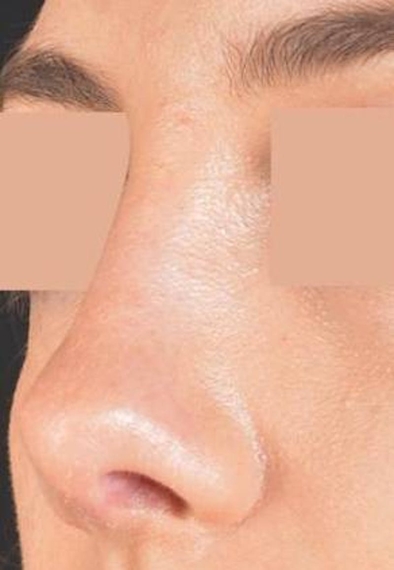 Rhinoplasty Before & After Gallery - Patient 338088 - Image 6
