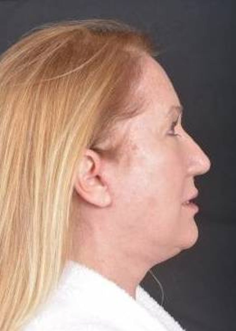 Facelift Before & After Gallery - Patient 366547 - Image 6