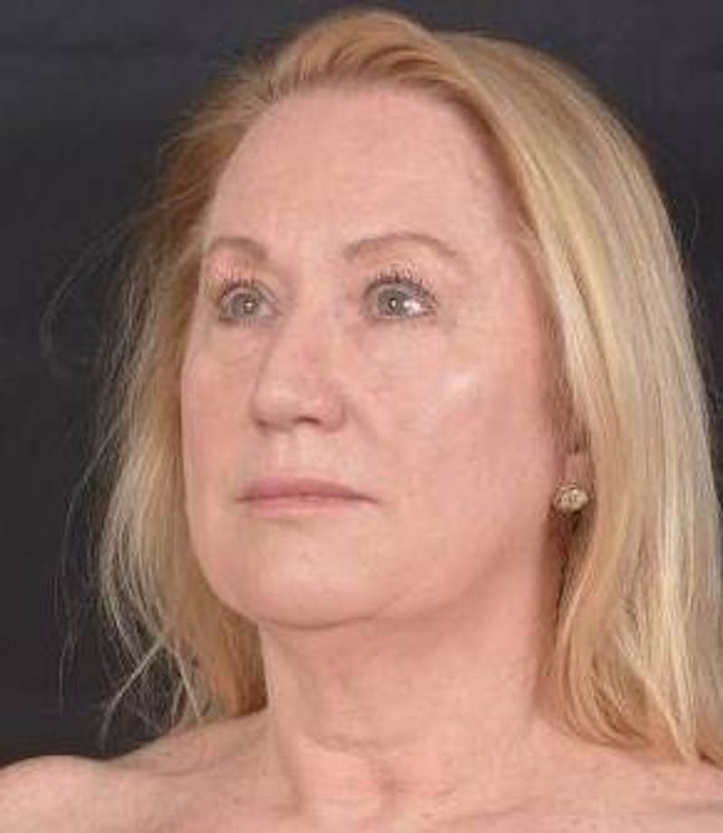 Facelift Before & After Gallery - Patient 366547 - Image 7