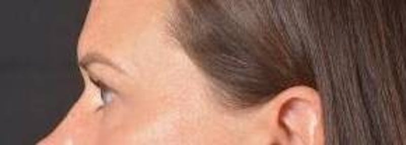 Blepharoplasty Before & After Gallery - Patient 120191 - Image 4