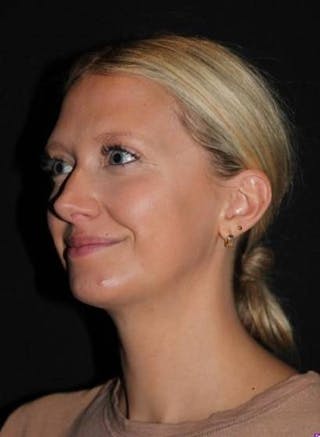 FaceTite Before & After Gallery - Patient 101371 - Image 4