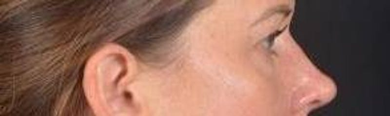 Blepharoplasty Before & After Gallery - Patient 120191 - Image 5