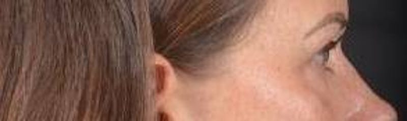 Blepharoplasty Before & After Gallery - Patient 120191 - Image 6