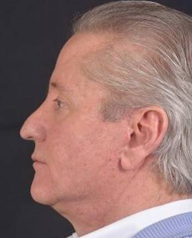Facelift Before & After Gallery - Patient 123656 - Image 4