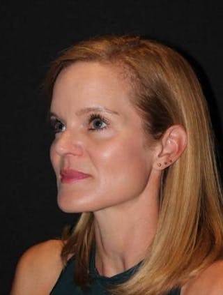 Rhinoplasty Before & After Gallery - Patient 129649 - Image 4