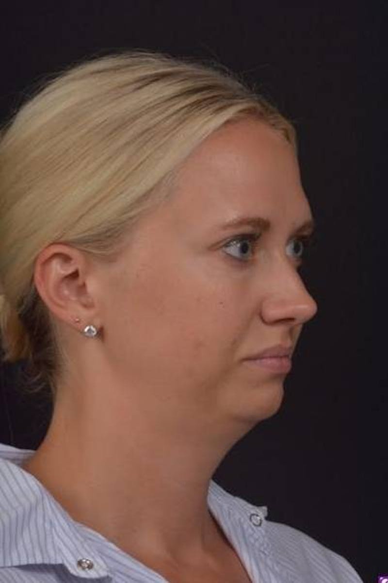 FaceTite Before & After Gallery - Patient 101371 - Image 7