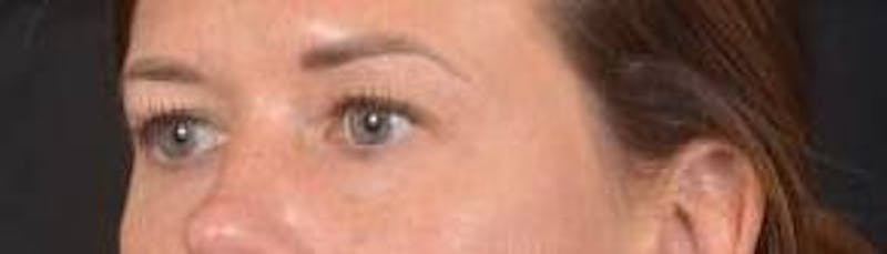 Blepharoplasty Before & After Gallery - Patient 120191 - Image 7