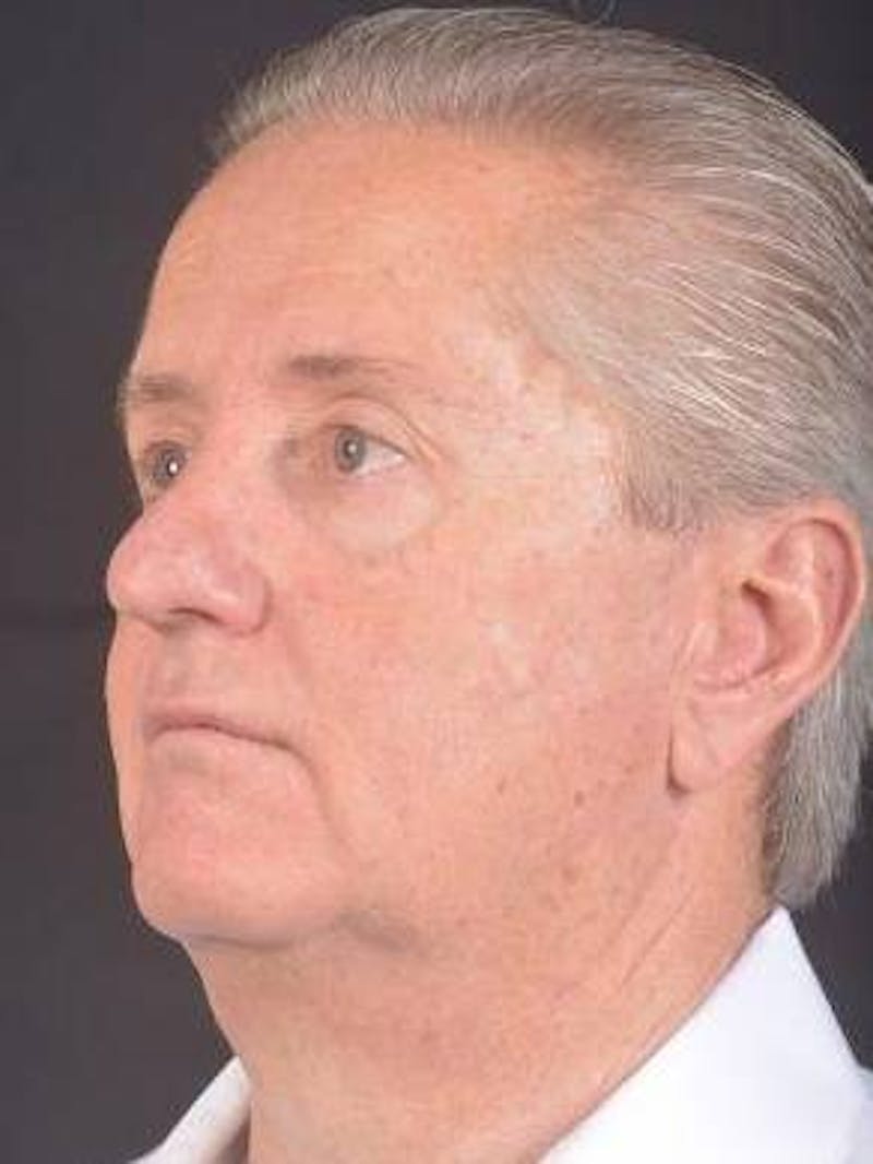 Facelift Before & After Gallery - Patient 123656 - Image 7