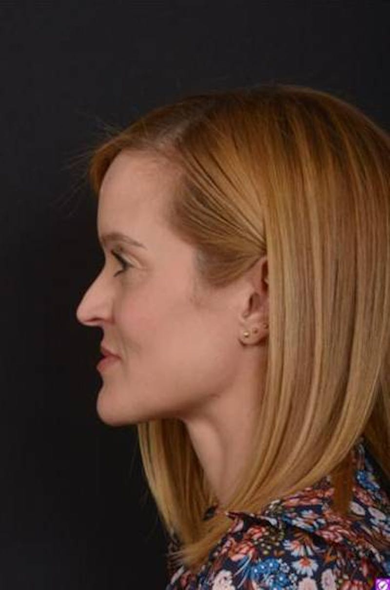 Rhinoplasty Before & After Gallery - Patient 129649 - Image 5