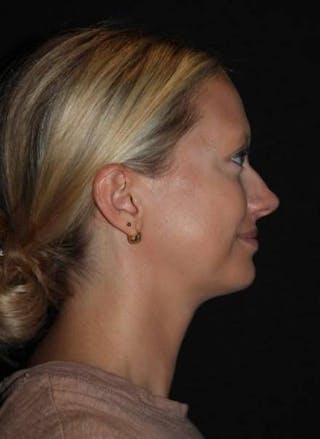 FaceTite Before & After Gallery - Patient 101371 - Image 10