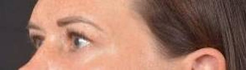 Blepharoplasty Before & After Gallery - Patient 120191 - Image 8