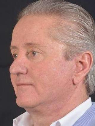 Facelift Before & After Gallery - Patient 123656 - Image 8