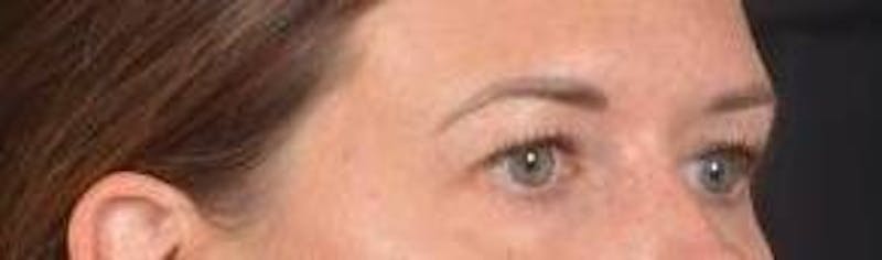 Blepharoplasty Before & After Gallery - Patient 120191 - Image 9
