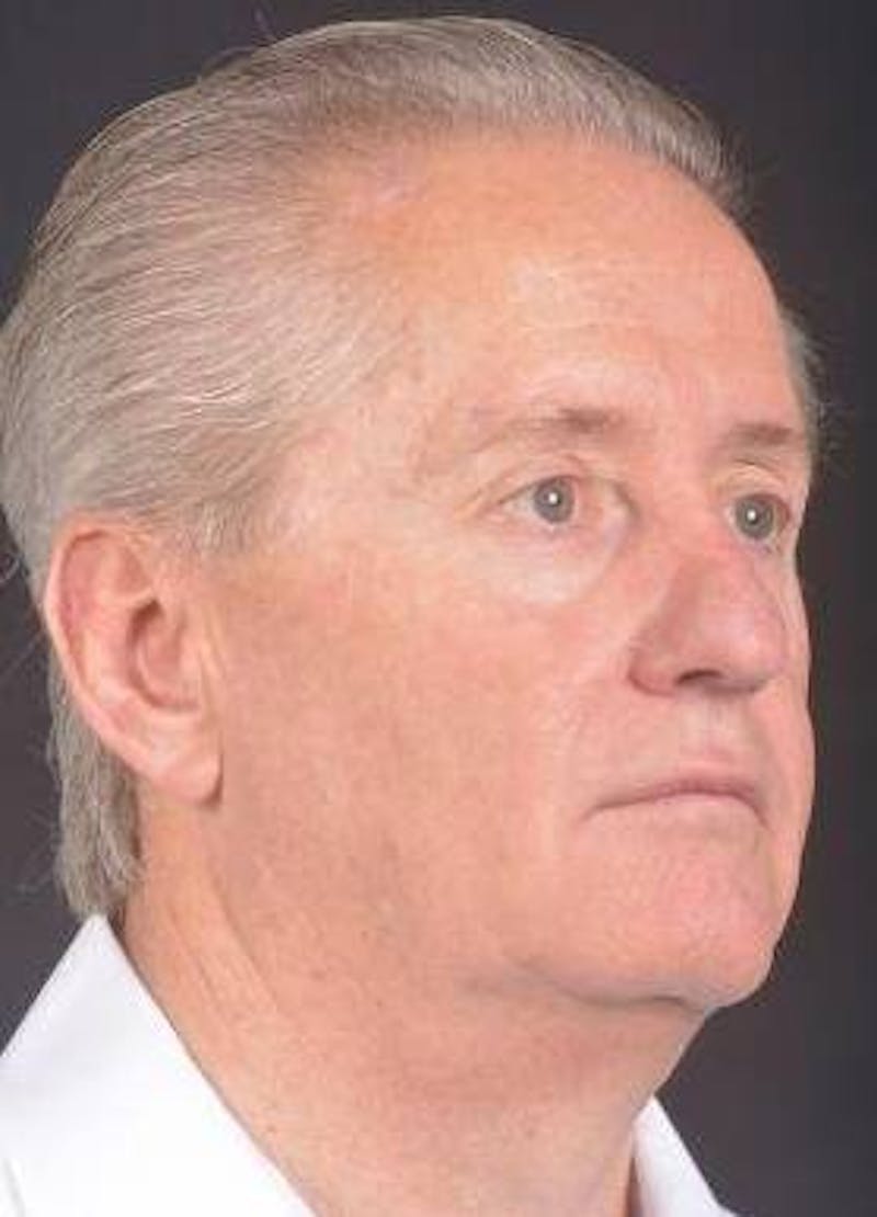 Facelift Before & After Gallery - Patient 123656 - Image 9