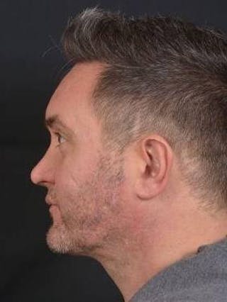 FaceTite Before & After Gallery - Patient 380864 - Image 4