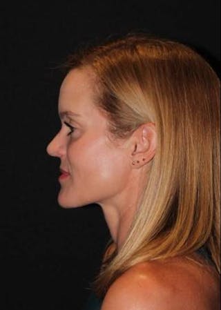 Rhinoplasty Before & After Gallery - Patient 129649 - Image 6