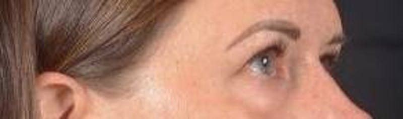 Blepharoplasty Before & After Gallery - Patient 120191 - Image 10