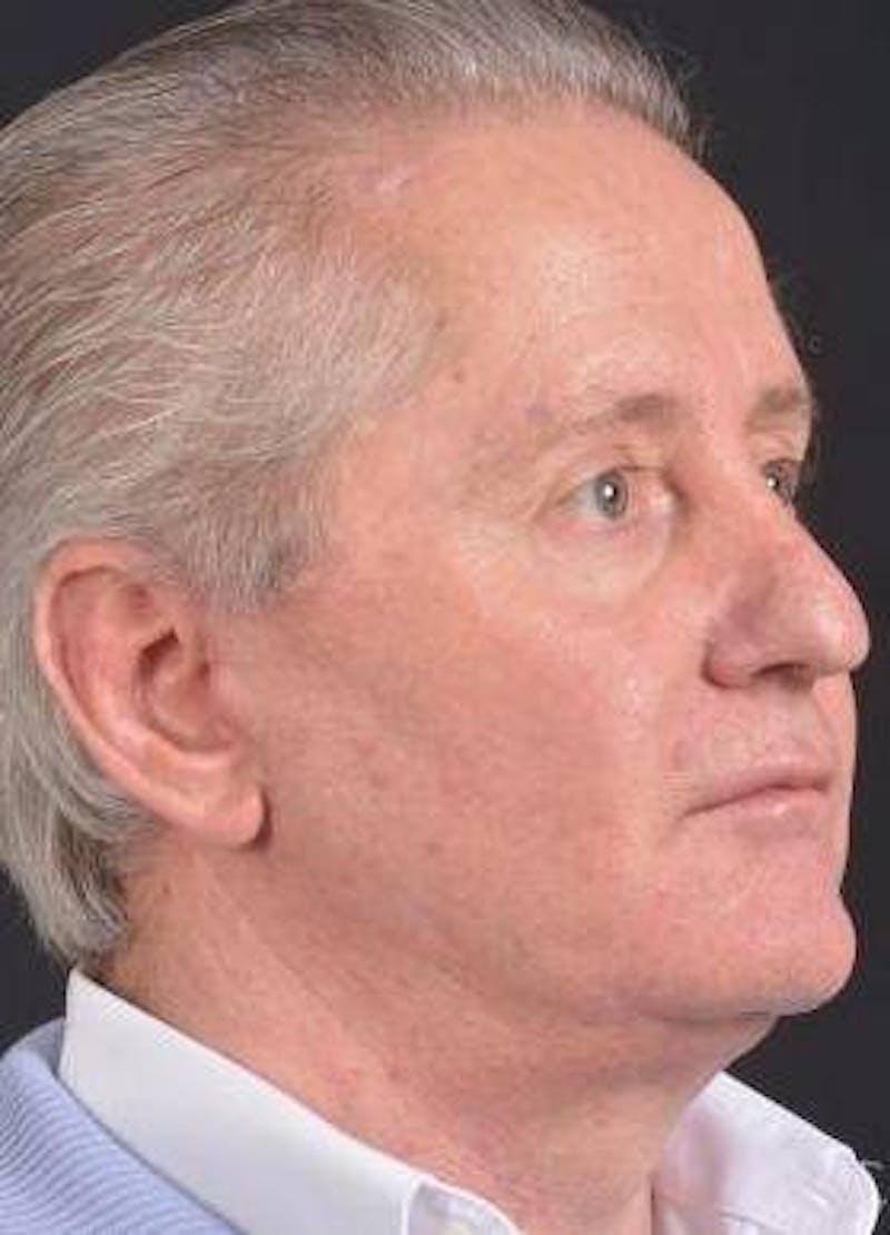 Facelift Before & After Gallery - Patient 123656 - Image 10