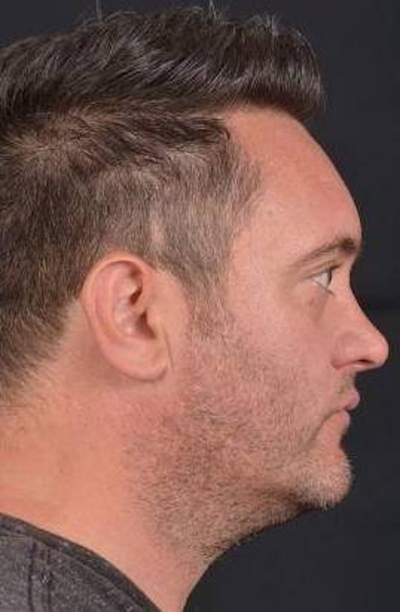 FaceTite Before & After Gallery - Patient 380864 - Image 5