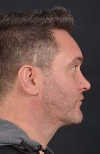 FaceTite Before & After Gallery - Patient 380864 - Image 6